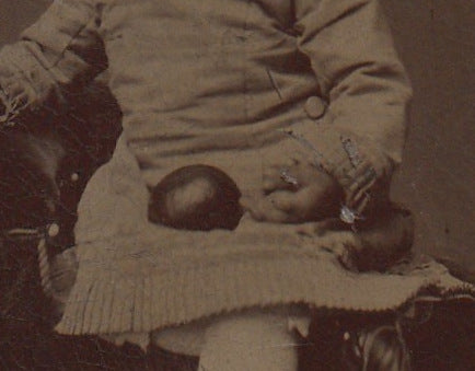 Deformed Hand - Symbrachydactyly - Victorian Child - Tintype Photo, c. 1800s - Close Up details