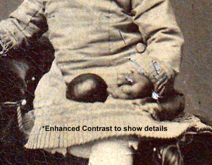 Deformed Hand - Symbrachydactyly - Victorian Child - Tintype Photo, c. 1800s Close Up Details Enhanced Contrast